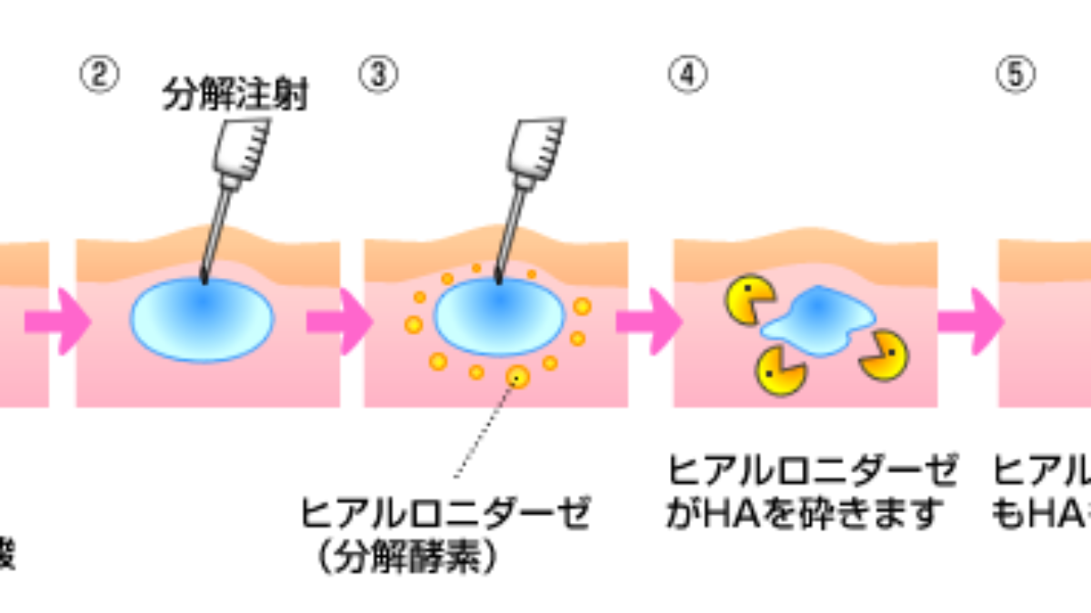 ヒアルロン酸分解注射 溶解注射 ヒアルロニダーゼ とは 注入療法の神田美容外科形成外科医院