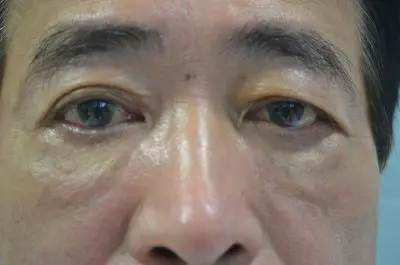 下眼瞼凹の治療５日後の結果