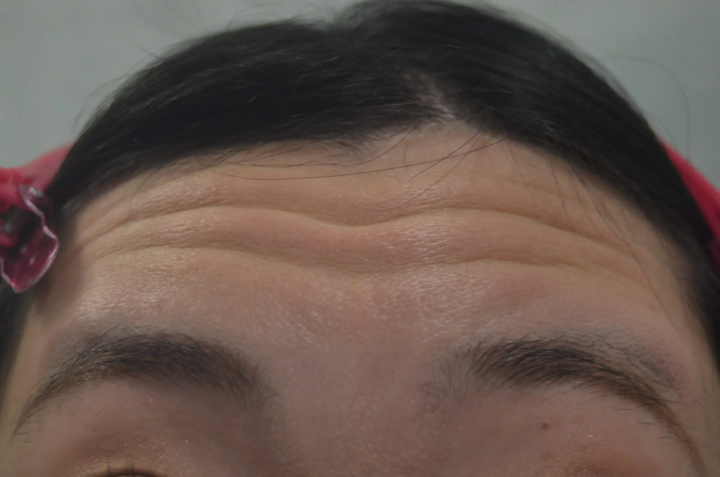 額の皺の治療