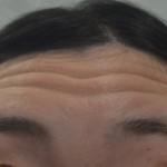 額の皺の治療