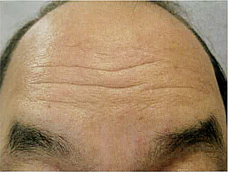 額右半分を Esthelis® Basic(Anteis 社,スイス)で治療する前