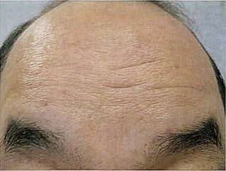 治療後10 ヵ月の所見。まだ右側のシワは目立たない