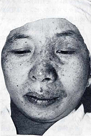 照射前。顔面左側血管腫。テスト照射は3ヵ所に行ない効果を認めた。