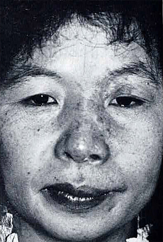 照射後1年。判定は良。軽度の赤みが残るが、巨視的な瘢痕はなく、薄い化粧で隠せるようになったと満足している。