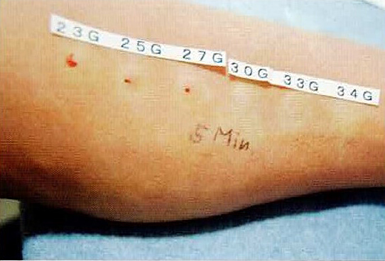 5 minutes after injection of Xylocaine® with epinephrine using 23G, 25G, 27G, 3 G, 33G, and 34G needles