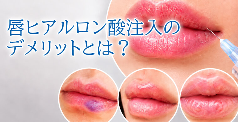 唇ヒアルロン酸注入のデメリットとは?後悔しないために知っておきたい注意点