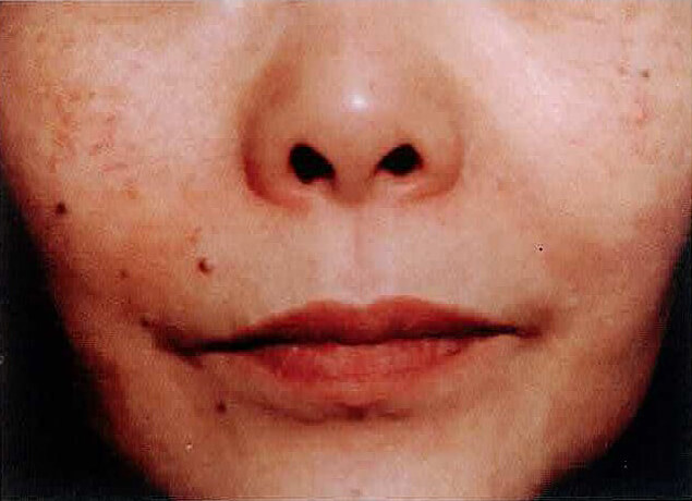 鼻唇溝にヒアルロン酸(Restylane)を注入して6カ月後。シワが目立たなくなっている