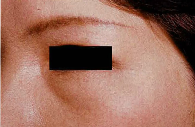 治療から2週間後。皺は見られなくなっている。